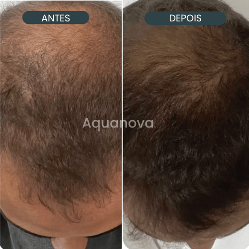 Micro Infusão Crescimento Capilar - [Kit Completo]